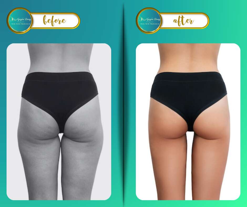 before after nâng mông