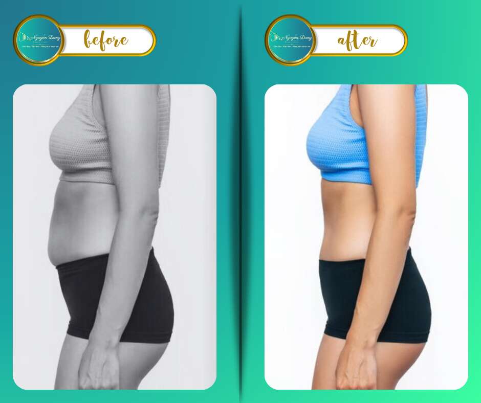 before after hút mỡ