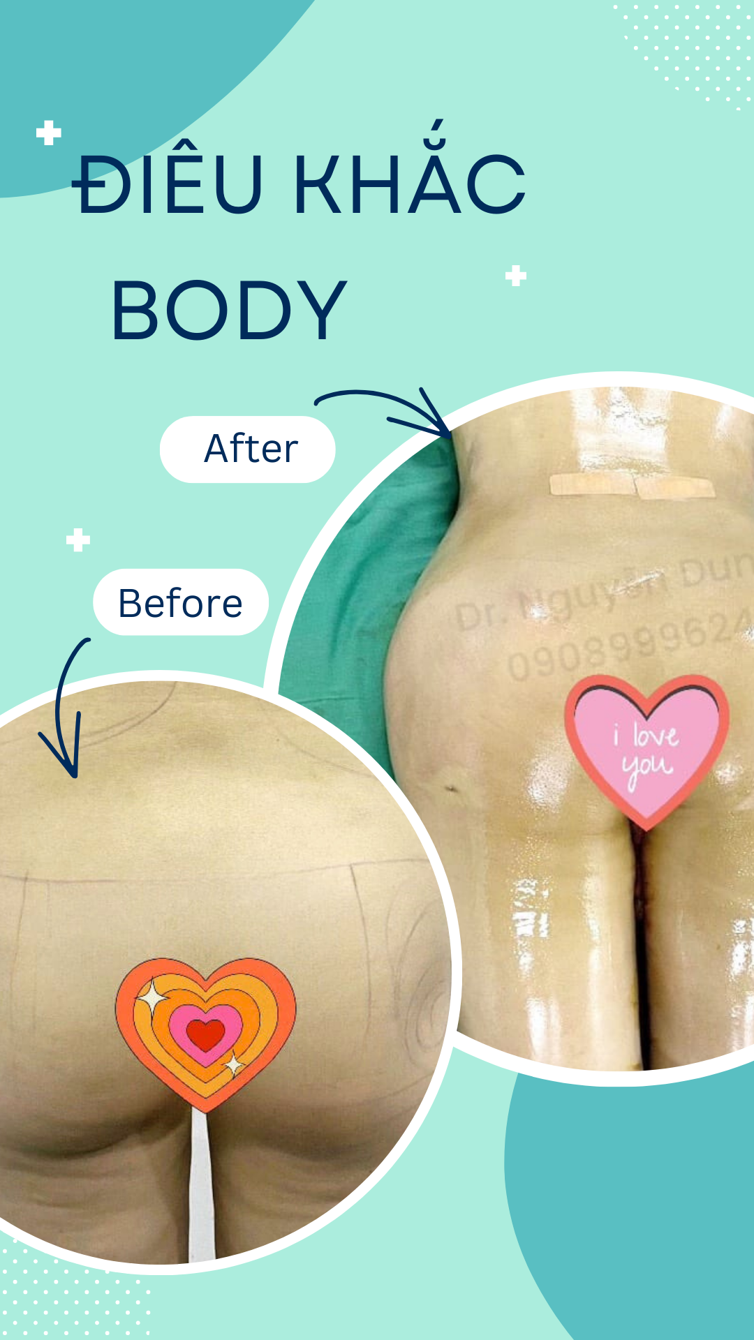 điêu khắc body tại dr nguyễn dung
