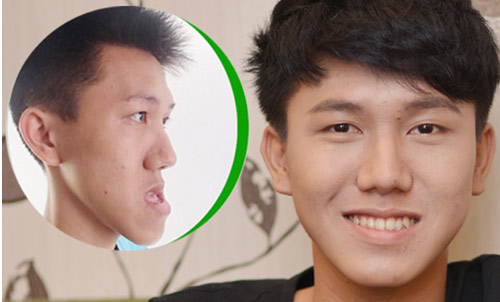 phẫu thuật hàm hô móm có đau không