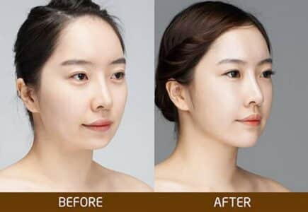 Độn cằm V-line Surgiform